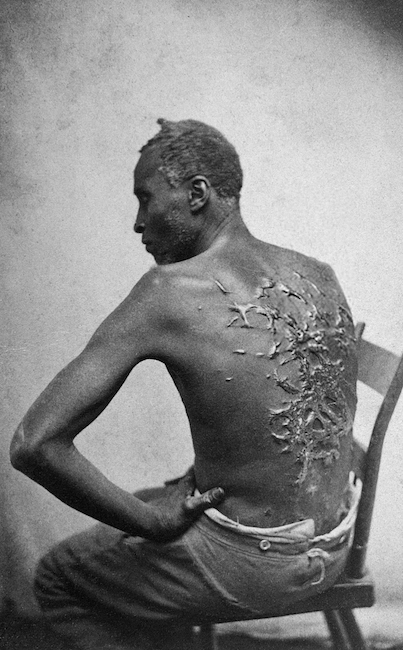 Scourged back by McPherson Oliver 1863 retouched